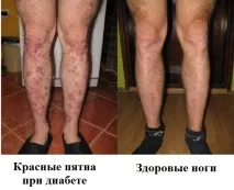 Червоні плями на ногах ступнях, з’явилися, сверблять червоні