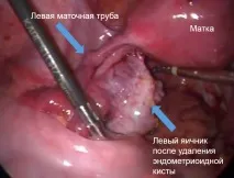 Лапароскопія кісти яєчника операція, післяопераційний період кісти