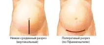 Лапароскопія кісти яєчника опис, види, як проходить операція яєчника