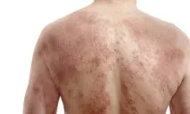 лікування