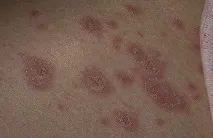 лишай