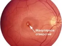 Макулярний розрив сітківки причини, симптоми та лікування патології причини