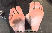 Мозоль на ступні - як її позбудеться мозолі