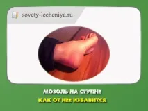 Мозоль на ступні - як її позбудеться мозоль
