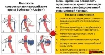 Накладення джгута при артеріальній кровотечі - Лікування кровотеч артеріальній
