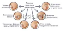 залози