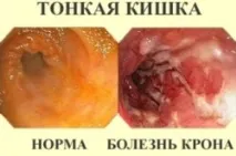 Харчування після операції на прямій кишці, що категорично заборонено прямій