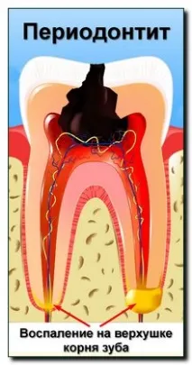 periodontitis