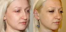 Плазмоліфтинг особи ефективність, протипоказання, відгуки, фото та ціна особи