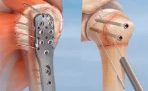 Пластини при переломах - класифікація та загальна характеристика класифікація
