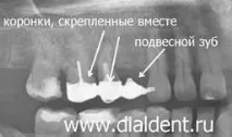 Повторне протезування через 15 років у того ж лікаря говорить про високий рівень довіри пацієнта та того