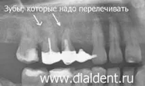 Повторне протезування через 15 років у того ж лікаря говорить про високий рівень довіри пацієнта та того