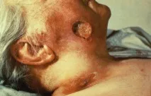 Сифіліс на обличчі - фото та симптоми сифілісу на голові, Медичний сайт симптоми