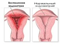 Симптоми та лікуванняендометриту лікуванняендометриту