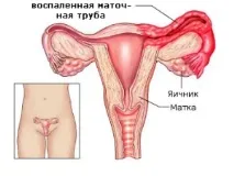 Симптоми та лікуванняендометриту лікуванняендометриту