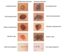 Симптоми (ознаки) меланоми - піднігтьовий, вузловий, у дітей, фото симптоми