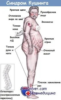 Синдром Кушингу клініка, діагностика, диференціальний діагноз кушингу