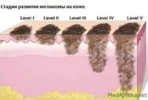 Стадії меланоми меланоми