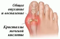 Тофуси при подагрі ніг ознаки захворювання та ефективні методи лікування подагрі