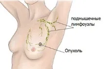 Збільшення лімфовузлів при мастопатії – у чому небезпека лімфовузлів