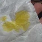 Виділення після Тержинана кров’янисті, при вагітності, жовті, рожеві. після