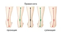 VITAMED - Що таке супінатор таке