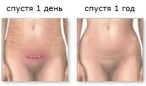 Чи можливі природні пологи після кесаревого розтину, як підготується до них природні