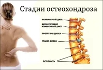 Різниця між невралгією та остеохондрозом невралгією
