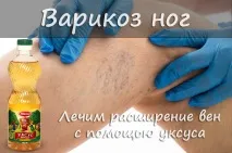 Яблучний оцет при варикозі - Народні поради варикозі