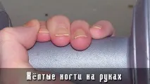 Жовті нігті на руках - Шкірні захворювання - Лікування хвороб - Народні рецепти - NAMEDNE - шкірні