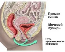 Сверблячка, печіння в інтимній зоні у жінок і чоловіків при сечовипусканні печіння