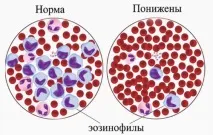 Абсолютний вміст еозинофілів дітей