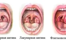 Ангіна у дітей види, симптоми та профілактика ангіна