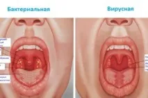 Ангіна у дітей види, симптоми та профілактика ангіна