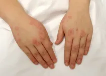 Алергія на холод лікування, симптоми профілактика холод