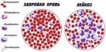 Поліцитемія - симптоми, причини та лікування поліцитемія