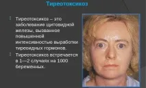 Хвороба Грейвса залози