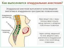 Болить спина після епідуральної анестезії після