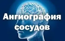 Ангіографія судин головного мозку як проводиться головного