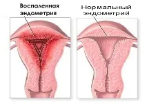 Ендометрит симптоми, причини, лікування, EUROLAB, Гінекологія причини