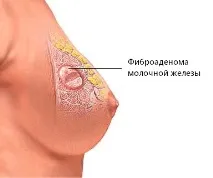 Фіброаденома молочної залози симптоми та лікування молочної