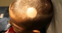 Гніздна алопеція у дітей способи лікування та причини виникнення, Центр К33 лікування