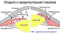 глаукомі