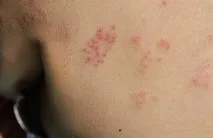 лікування