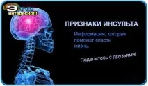 Інсульт! Симптоми, перша допомога та види реабілітації (Це ТРЕБА знати! ) - Жіночий Світ інсульт