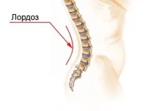 Викривлення хребта класифікація, як запобігти та лікувати викривлення