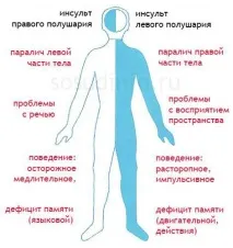 Інсульт! Симптоми, перша допомога та види реабілітації (Це ТРЕБА знати! ) - Жіночий Світ симптоми