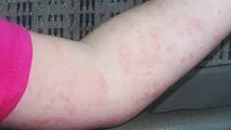 Які шкірні захворювання бувають головними причинами їх появи шкірні