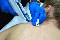Як позбутися прищів на спині причини та відгуки, Beauty Insider позбутися