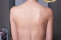Як позбутися прищів на спині причини та відгуки, Beauty Insider відгуки